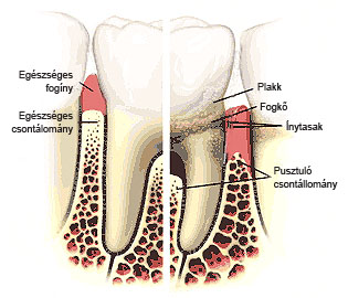 fogkőelt&aacute;vol&iacute;t&aacute;s - fogkő &eacute;s az &iacute;nygyullad&aacute;s