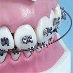 fogszab&aacute;lyoz&aacute;s - leone