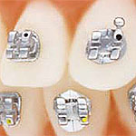 fogszab&aacute;lyoz&aacute;s - ormco